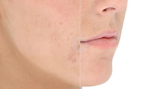 Light Stim | For Acne - Spaffective