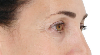 Light Stim | For Wrinkles - Spaffective